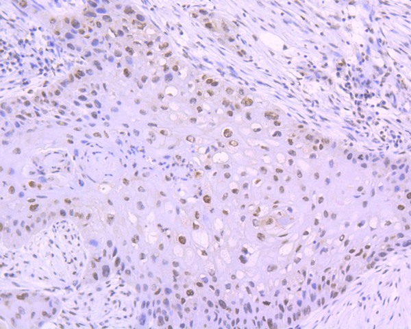 Immunohistochemical analysis of paraffin-embedded human lung carcinoma tissue using anti-Phospho-JAK2(Y1007+Y1008) antibody. The section was pre-treated using heat mediated antigen retrieval with Tris-EDTA buffer (pH 8.0-8.4) for 20 minutes.The tissues were blocked in 5% BSA for 30 minutes at room temperature, washed with ddH2O and PBS, and then probed with the primary antibody (ET1607-34, 1/200) for 30 minutes at room temperature. The detection was performed using an HRP conjugated compact polymer system. DAB was used as the chromogen. Tissues were counterstained with hematoxylin and mounted with DPX.