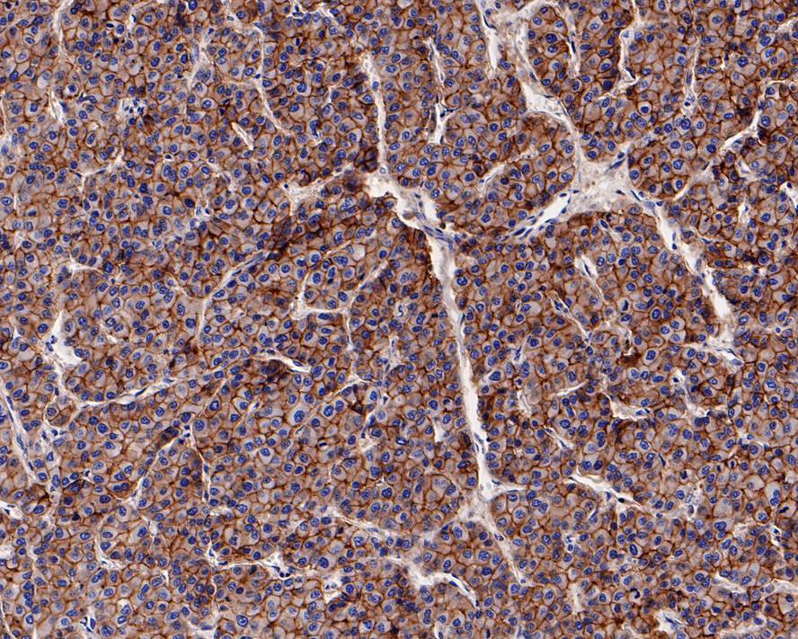 Immunohistochemical analysis of paraffin-embedded human liver carcinoma tissue with Rabbit anti-N Cadherin antibody (ET1607-37) at 1/1,000 dilution.<br />
<br />
The section was pre-treated using heat mediated antigen retrieval with Tris-EDTA buffer (pH 9.0) for 20 minutes. The tissues were blocked in 1% BSA for 20 minutes at room temperature, washed with ddH2O and PBS, and then probed with the primary antibody (ET1607-37) at 1/1,000 dilution for 1 hour at room temperature. The detection was performed using an HRP conjugated compact polymer system. DAB was used as the chromogen. Tissues were counterstained with hematoxylin and mounted with DPX.