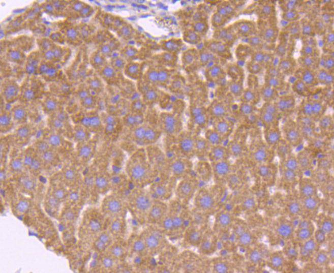 Immunohistochemical analysis of paraffin-embedded human lung carcinoma tissue using anti-Smad3 antibody. The section was pre-treated using heat mediated antigen retrieval with Tris-EDTA buffer (pH 8.0-8.4) for 20 minutes.The tissues were blocked in 5% BSA for 30 minutes at room temperature, washed with ddH2O and PBS, and then probed with the primary antibody (ET1607-41, 1/50) for 30 minutes at room temperature. The detection was performed using an HRP conjugated compact polymer system. DAB was used as the chromogen. Tissues were counterstained with hematoxylin and mounted with DPX.