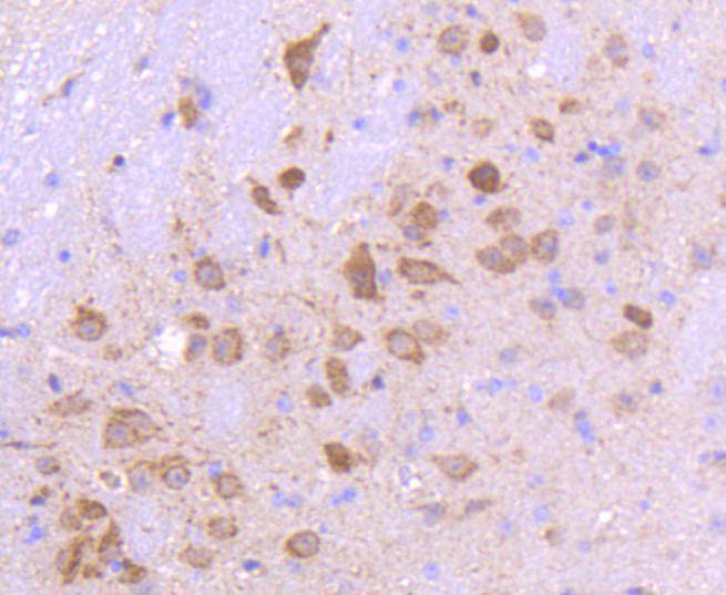 Immunohistochemical analysis of paraffin-embedded human breast carcinoma tissue using anti-Smad3 antibody. The section was pre-treated using heat mediated antigen retrieval with Tris-EDTA buffer (pH 8.0-8.4) for 20 minutes.The tissues were blocked in 5% BSA for 30 minutes at room temperature, washed with ddH2O and PBS, and then probed with the primary antibody (ET1607-41, 1/50) for 30 minutes at room temperature. The detection was performed using an HRP conjugated compact polymer system. DAB was used as the chromogen. Tissues were counterstained with hematoxylin and mounted with DPX.
