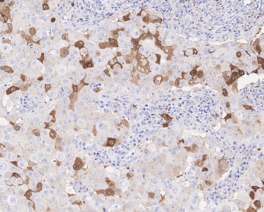 ICC staining of CDK1 in MCF-7 cells (green). Formalin fixed cells were permeabilized with 0.1% Triton X-100 in TBS for 10 minutes at room temperature and blocked with 1% Blocker BSA for 15 minutes at room temperature. Cells were probed with the primary antibody (ET1607-51, 1/50) for 1 hour at room temperature, washed with PBS. Alexa Fluor®488 Goat anti-Rabbit IgG was used as the secondary antibody at 1/1,000 dilution. The nuclear counter stain is DAPI (blue).