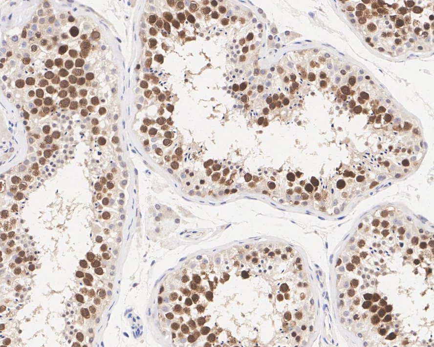 Immunohistochemical analysis of paraffin-embedded human breast carcinoma tissue using anti-CDK1 antibody. The section was pre-treated using heat mediated antigen retrieval with Tris-EDTA buffer (pH 8.0-8.4) for 20 minutes.The tissues were blocked in 5% BSA for 30 minutes at room temperature, washed with ddH2O and PBS, and then probed with the primary antibody (ET1607-51, 1/50) for 30 minutes at room temperature. The detection was performed using an HRP conjugated compact polymer system. DAB was used as the chromogen. Tissues were counterstained with hematoxylin and mounted with DPX.
