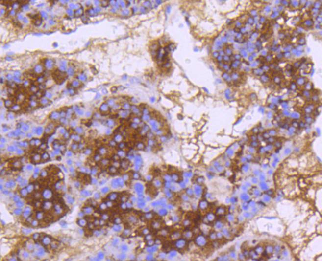 Immunohistochemical analysis of paraffin-embedded human liver carcinoma tissue using anti-DNAJC15 antibody. The section was pre-treated using heat mediated antigen retrieval with Tris-EDTA buffer (pH 8.0-8.4) for 20 minutes.The tissues were blocked in 5% BSA for 30 minutes at room temperature, washed with ddH2O and PBS, and then probed with the primary antibody (ET1607-52, 1/200) for 30 minutes at room temperature. The detection was performed using an HRP conjugated compact polymer system. DAB was used as the chromogen. Tissues were counterstained with hematoxylin and mounted with DPX.