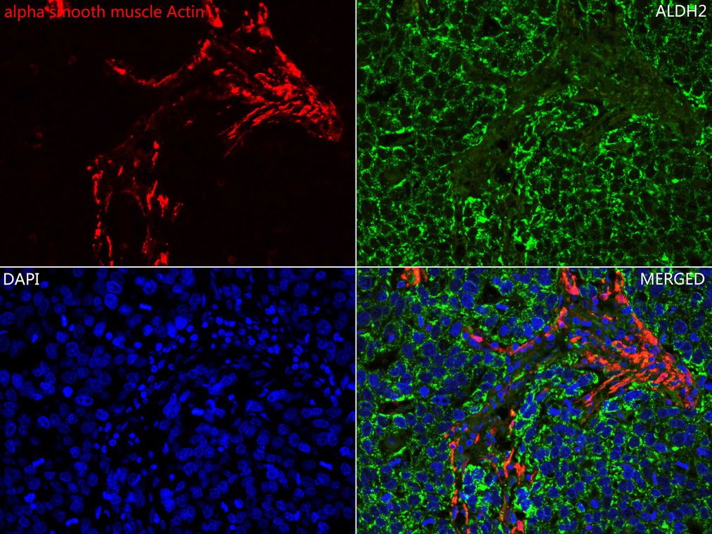 Immunohistochemical analysis of paraffin-embedded human tonsil tissue using anti-alpha smooth muscle Actin antibody. The section was pre-treated using heat mediated antigen retrieval with Tris-EDTA buffer (pH 8.0-8.4) for 20 minutes.The tissues were blocked in 5% BSA for 30 minutes at room temperature, washed with ddH2O and PBS, and then probed with the primary antibody (ET1607-53, 1/50) for 30 minutes at room temperature. The detection was performed using an HRP conjugated compact polymer system. DAB was used as the chromogen. Tissues were counterstained with hematoxylin and mounted with DPX.