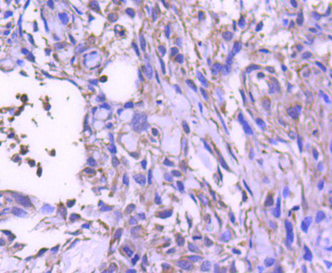 Immunohistochemical analysis of paraffin-embedded human breast carcinoma tissue with Rabbit anti-STAT6 antibody (ET1607-61) at 1/50 dilution.<br />
<br />
The section was pre-treated using heat mediated antigen retrieval with Tris-EDTA buffer (pH 9.0) for 20 minutes. The tissues were blocked in 1% BSA for 20 minutes at room temperature, washed with ddH2O and PBS, and then probed with the primary antibody (ET1607-61) at 1/50 dilution for 1 hour at room temperature. The detection was performed using an HRP conjugated compact polymer system. DAB was used as the chromogen. Tissues were counterstained with hematoxylin and mounted with DPX.