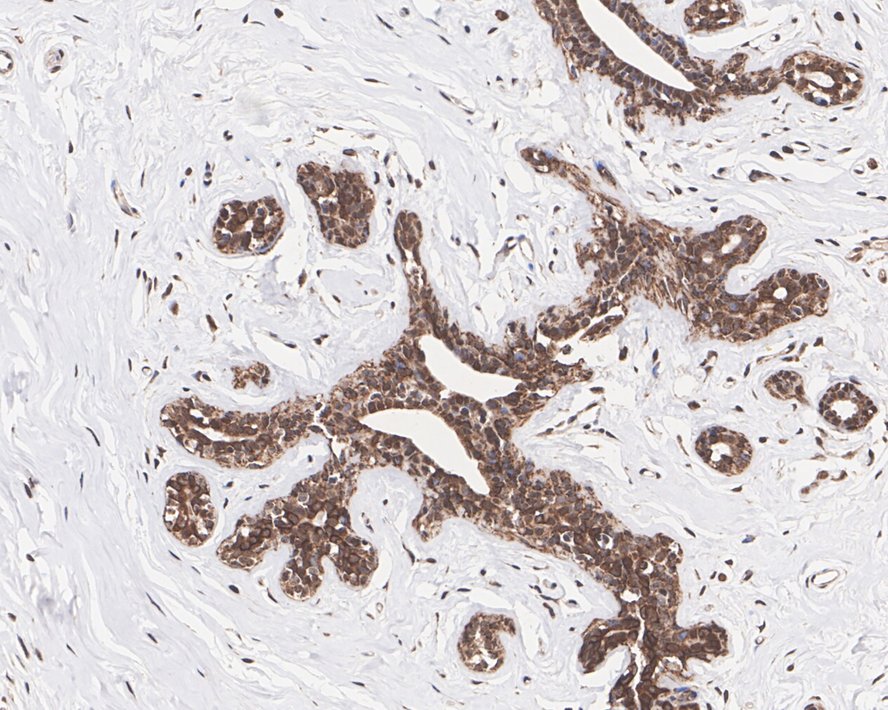 Immunohistochemical analysis of paraffin-embedded human breast carcinoma tissue using anti-GSK3 beta antibody. The section was pre-treated using heat mediated antigen retrieval with Tris-EDTA buffer (pH 8.0-8.4) for 20 minutes.The tissues were blocked in 5% BSA for 30 minutes at room temperature, washed with ddH2O and PBS, and then probed with the primary antibody (ET1607-71, 1/50) for 30 minutes at room temperature. The detection was performed using an HRP conjugated compact polymer system. DAB was used as the chromogen. Tissues were counterstained with hematoxylin and mounted with DPX.