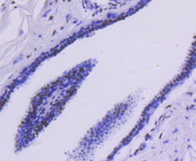 Immunohistochemical analysis of paraffin-embedded human breast carcinoma tissue using anti-HDAC2 antibody. The section was pre-treated using heat mediated antigen retrieval with Tris-EDTA buffer (pH 8.0-8.4) for 20 minutes.The tissues were blocked in 5% BSA for 30 minutes at room temperature, washed with ddH2O and PBS, and then probed with the primary antibody (ET1607-78, 1/50) for 30 minutes at room temperature. The detection was performed using an HRP conjugated compact polymer system. DAB was used as the chromogen. Tissues were counterstained with hematoxylin and mounted with DPX.