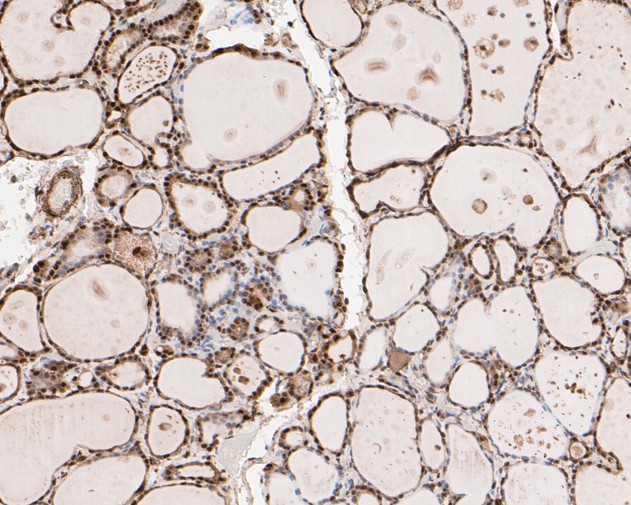 Immunohistochemical analysis of paraffin-embedded human lung tissue using anti-Phospho-HSF1(S326) antibody. The section was pre-treated using heat mediated antigen retrieval with sodium citrate buffer (pH 6.0) for 20 minutes. The tissues were blocked in 5% BSA for 30 minutes at room temperature, washed with ddH2O and PBS, and then probed with the primary antibody (ET1608-11, 1/50)  for 30 minutes at room temperature. The detection was performed using an HRP conjugated compact polymer system. DAB was used as the chromogen. Tissues were counterstained with hematoxylin and mounted with DPX.