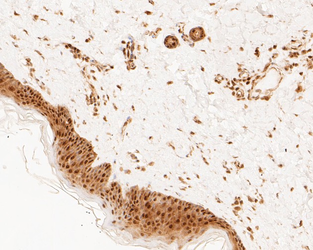 Immunohistochemical analysis of paraffin-embedded human thyroid tissue using anti-Phospho-HSF1(S326) antibody. The section was pre-treated using heat mediated antigen retrieval with sodium citrate buffer (pH 6.0) for 20 minutes. The tissues were blocked in 5% BSA for 30 minutes at room temperature, washed with ddH2O and PBS, and then probed with the primary antibody (ET1608-11, 1/50)  for 30 minutes at room temperature. The detection was performed using an HRP conjugated compact polymer system. DAB was used as the chromogen. Tissues were counterstained with hematoxylin and mounted with DPX.