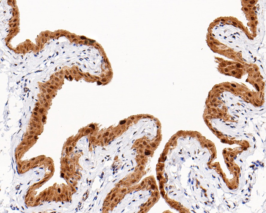 Immunohistochemical analysis of paraffin-embedded human pancreas tissue using anti-Phospho-HSF1(S326) antibody. The section was pre-treated using heat mediated antigen retrieval with sodium citrate buffer (pH 6.0) for 20 minutes. The tissues were blocked in 5% BSA for 30 minutes at room temperature, washed with ddH2O and PBS, and then probed with the primary antibody (ET1608-11, 1/50)  for 30 minutes at room temperature. The detection was performed using an HRP conjugated compact polymer system. DAB was used as the chromogen. Tissues were counterstained with hematoxylin and mounted with DPX.