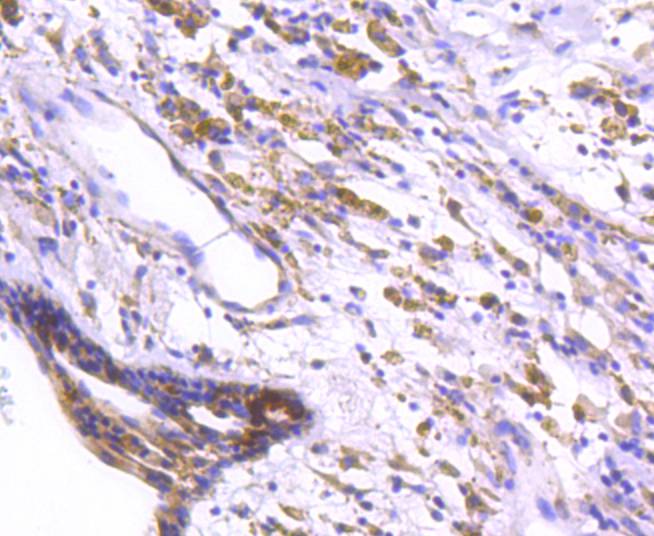 Immunohistochemical analysis of paraffin-embedded human breast carcinoma tissue using anti-DARPP32 antibody. The section was pre-treated using heat mediated antigen retrieval with Tris-EDTA buffer (pH 8.0-8.4) for 20 minutes.The tissues were blocked in 5% BSA for 30 minutes at room temperature, washed with ddH2O and PBS, and then probed with the primary antibody (ET1608-23, 1/50) for 30 minutes at room temperature. The detection was performed using an HRP conjugated compact polymer system. DAB was used as the chromogen. Tissues were counterstained with hematoxylin and mounted with DPX.