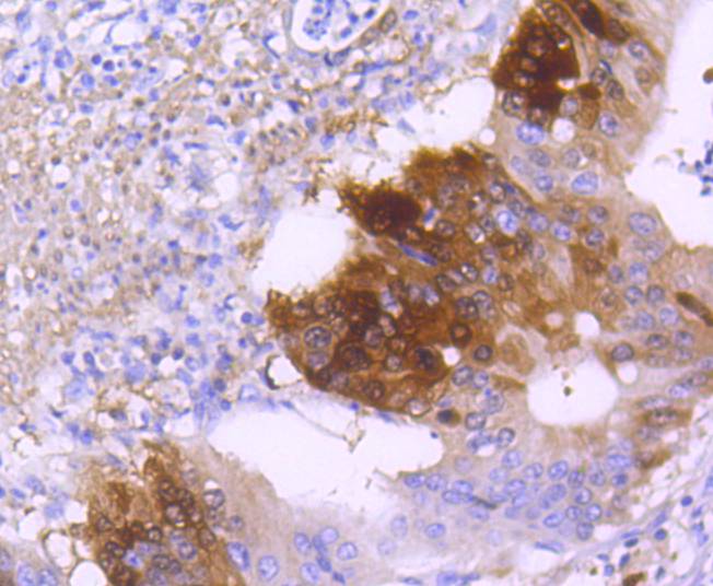 Immunohistochemical analysis of paraffin-embedded human stomach carcinoma tissue using anti-DARPP32 antibody. The section was pre-treated using heat mediated antigen retrieval with Tris-EDTA buffer (pH 8.0-8.4) for 20 minutes.The tissues were blocked in 5% BSA for 30 minutes at room temperature, washed with ddH2O and PBS, and then probed with the primary antibody (ET1608-23, 1/50) for 30 minutes at room temperature. The detection was performed using an HRP conjugated compact polymer system. DAB was used as the chromogen. Tissues were counterstained with hematoxylin and mounted with DPX.