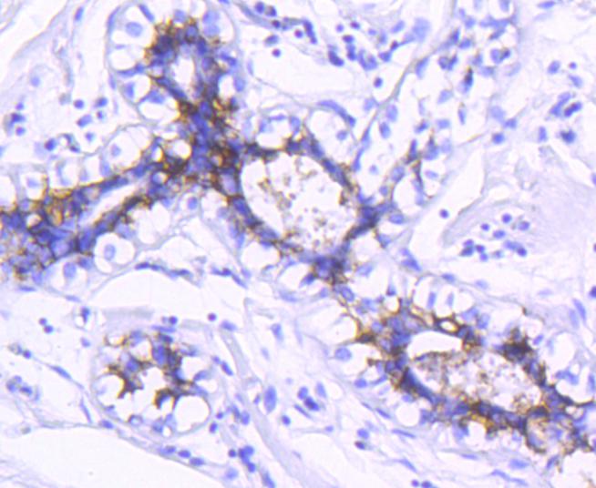 Immunohistochemical analysis of paraffin-embedded human breast carcinoma tissue using anti-EpCAM antibody. The section was pre-treated using heat mediated antigen retrieval with Tris-EDTA buffer (pH 8.0-8.4) for 20 minutes.The tissues were blocked in 5% BSA for 30 minutes at room temperature, washed with ddH2O and PBS, and then probed with the primary antibody (ET1608-26, 1/50) for 30 minutes at room temperature. The detection was performed using an HRP conjugated compact polymer system. DAB was used as the chromogen. Tissues were counterstained with hematoxylin and mounted with DPX.