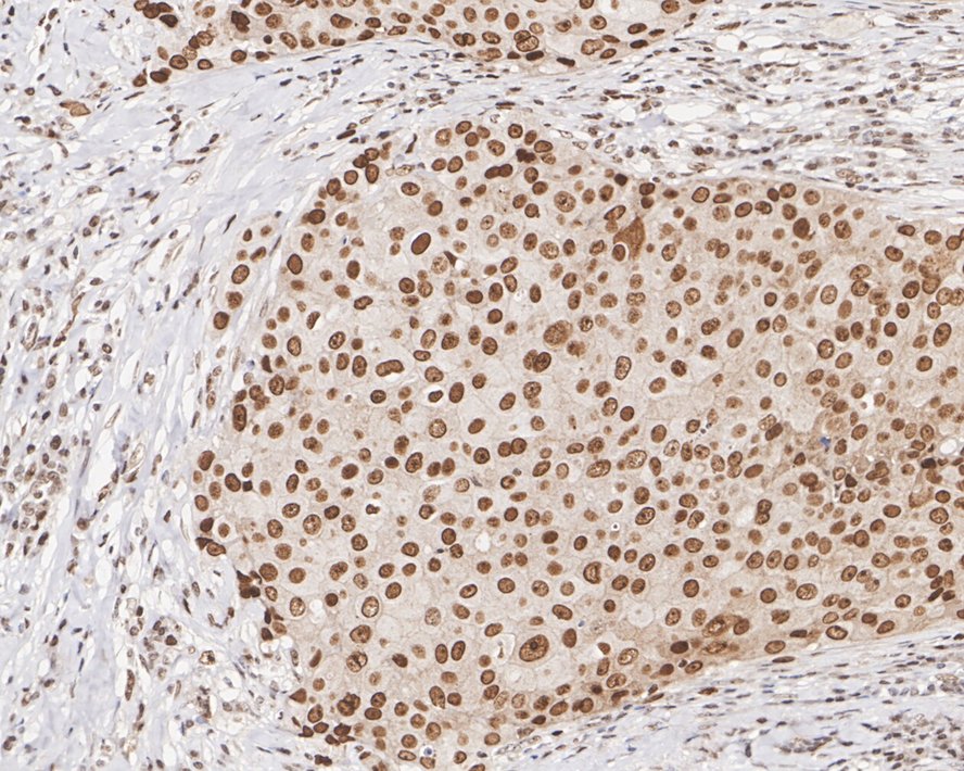Immunohistochemical analysis of paraffin-embedded human breast carcinoma tissue using anti-Phospho-Nrf2(S40) antibody. The section was pre-treated using heat mediated antigen retrieval with Tris-EDTA buffer (pH 9.0) for 20 minutes.The tissues were blocked in 1% BSA for 30 minutes at room temperature, washed with ddH2O and PBS, and then probed with the primary antibody (ET1608-28, 1/50) for 30 minutes at room temperature. The detection was performed using an HRP conjugated compact polymer system. DAB was used as the chromogen. Tissues were counterstained with hematoxylin and mounted with DPX.