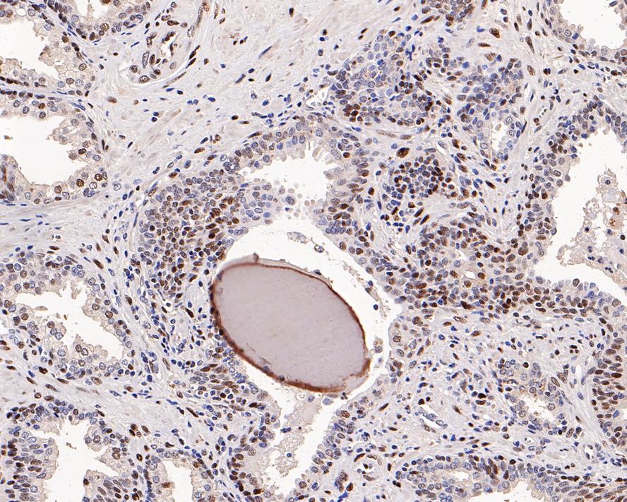 Immunohistochemical analysis of paraffin-embedded human breast carcinoma tissue with Rabbit anti-c-Jun antibody (ET1608-3) at 1/1,000 dilution.<br />
<br />
The section was pre-treated using heat mediated antigen retrieval with sodium citrate buffer (pH 6.0) for 2 minutes. The tissues were blocked in 1% BSA for 20 minutes at room temperature, washed with ddH2O and PBS, and then probed with the primary antibody (ET1608-3) at 1/1,000 dilution for 1 hour at room temperature. The detection was performed using an HRP conjugated compact polymer system. DAB was used as the chromogen. Tissues were counterstained with hematoxylin and mounted with DPX.