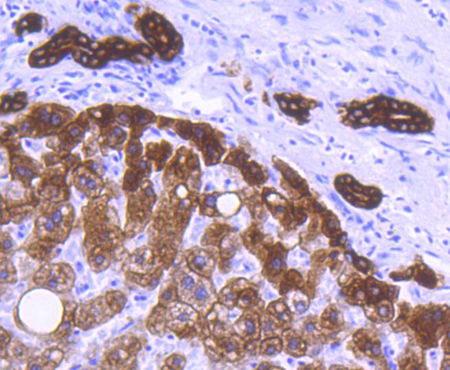 Immunohistochemical analysis of paraffin-embedded human breast carcinoma tissue using anti-Cytokeratin 8 antibody. The section was pre-treated using heat mediated antigen retrieval with Tris-EDTA buffer (pH 8.0-8.4) for 20 minutes.The tissues were blocked in 5% BSA for 30 minutes at room temperature, washed with ddH2O and PBS, and then probed with the primary antibody (ET1608-32, 1/50) for 30 minutes at room temperature. The detection was performed using an HRP conjugated compact polymer system. DAB was used as the chromogen. Tissues were counterstained with hematoxylin and mounted with DPX.