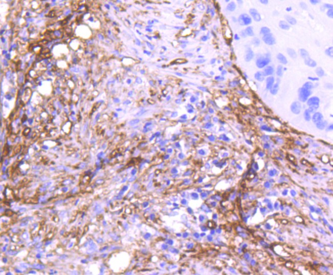 Immunohistochemical analysis of paraffin-embedded human lung carcinoma tissue using anti-CD90 antibody. The section was pre-treated using heat mediated antigen retrieval with Tris-EDTA buffer (pH 8.0-8.4) for 20 minutes.The tissues were blocked in 5% BSA for 30 minutes at room temperature, washed with ddH2O and PBS, and then probed with the primary antibody (ET1608-46, 1/50) for 30 minutes at room temperature. The detection was performed using an HRP conjugated compact polymer system. DAB was used as the chromogen. Tissues were counterstained with hematoxylin and mounted with DPX.