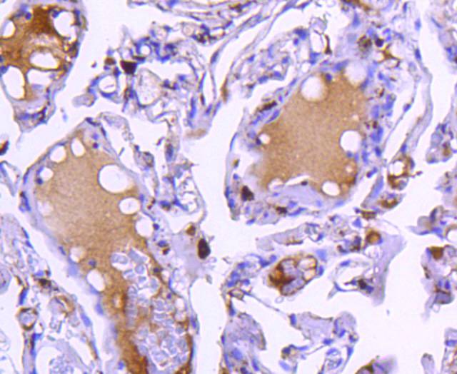 Immunohistochemical analysis of paraffin-embedded human lung tissue using anti-Cathepsin D antibody. The section was pre-treated using heat mediated antigen retrieval with Tris-EDTA buffer (pH 8.0-8.4) for 20 minutes.The tissues were blocked in 5% BSA for 30 minutes at room temperature, washed with ddH2O and PBS, and then probed with the primary antibody (ET1608-49, 1/50) for 30 minutes at room temperature. The detection was performed using an HRP conjugated compact polymer system. DAB was used as the chromogen. Tissues were counterstained with hematoxylin and mounted with DPX.
