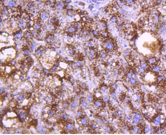 Immunohistochemical analysis of paraffin-embedded human liver tissue using anti-Cathepsin D antibody. The section was pre-treated using heat mediated antigen retrieval with Tris-EDTA buffer (pH 8.0-8.4) for 20 minutes.The tissues were blocked in 5% BSA for 30 minutes at room temperature, washed with ddH2O and PBS, and then probed with the primary antibody (ET1608-49, 1/50) for 30 minutes at room temperature. The detection was performed using an HRP conjugated compact polymer system. DAB was used as the chromogen. Tissues were counterstained with hematoxylin and mounted with DPX.