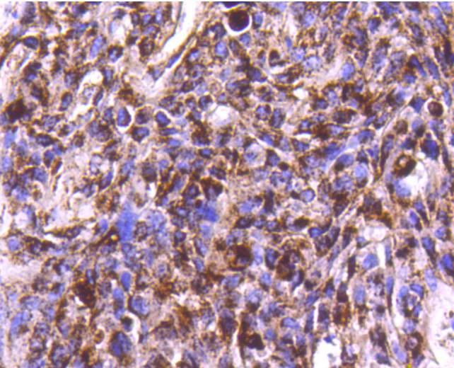 Immunohistochemical analysis of paraffin-embedded human breast carcinoma tissue using anti-Cathepsin D antibody. The section was pre-treated using heat mediated antigen retrieval with Tris-EDTA buffer (pH 8.0-8.4) for 20 minutes.The tissues were blocked in 5% BSA for 30 minutes at room temperature, washed with ddH2O and PBS, and then probed with the primary antibody (ET1608-49, 1/50) for 30 minutes at room temperature. The detection was performed using an HRP conjugated compact polymer system. DAB was used as the chromogen. Tissues were counterstained with hematoxylin and mounted with DPX.