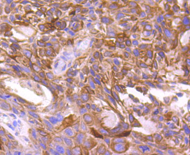 Immunohistochemical analysis of paraffin-embedded human breast carcinoma tissue using anti-mTOR antibody. The section was pre-treated using heat mediated antigen retrieval with Tris-EDTA buffer (pH 8.0-8.4) for 20 minutes.The tissues were blocked in 5% BSA for 30 minutes at room temperature, washed with ddH2O and PBS, and then probed with the primary antibody (ET1608-5, 1/50) for 30 minutes at room temperature. The detection was performed using an HRP conjugated compact polymer system. DAB was used as the chromogen. Tissues were counterstained with hematoxylin and mounted with DPX.