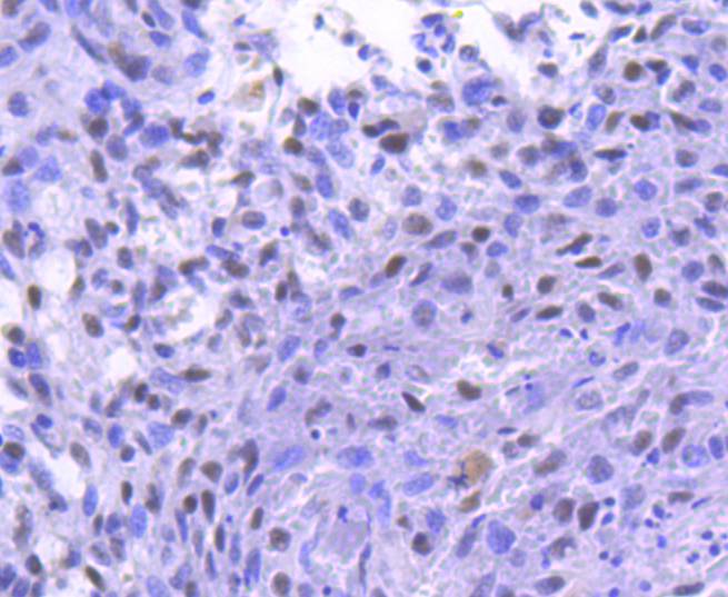 Immunohistochemical analysis of paraffin-embedded human breast carcinoma tissue using anti-Phospho-RSK1 p90(T359+S363) antibody. The section was pre-treated using heat mediated antigen retrieval with sodium citrate buffer (pH 6.0) for 20 minutes. The tissues were blocked in 1% BSA for 30 minutes at room temperature, washed with ddH2O and PBS, and then probed with the primary antibody (ET1608-53, 1/50)  for 30 minutes at room temperature. The detection was performed using an HRP conjugated compact polymer system. DAB was used as the chromogen. Tissues were counterstained with hematoxylin and mounted with DPX.