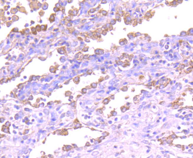 Immunohistochemical analysis of paraffin-embedded human lung carcinoma tissue using anti-ASK1 antibody. The section was pre-treated using heat mediated antigen retrieval with Tris-EDTA buffer (pH 8.0-8.4) for 20 minutes.The tissues were blocked in 5% BSA for 30 minutes at room temperature, washed with ddH2O and PBS, and then probed with the primary antibody (ET1608-54, 1/50) for 30 minutes at room temperature. The detection was performed using an HRP conjugated compact polymer system. DAB was used as the chromogen. Tissues were counterstained with hematoxylin and mounted with DPX.