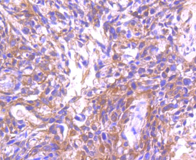 Immunohistochemical analysis of paraffin-embedded human breastcarcinoma tissue using anti-ASK1 antibody. The section was pre-treated using heat mediated antigen retrieval with Tris-EDTA buffer (pH 8.0-8.4) for 20 minutes.The tissues were blocked in 5% BSA for 30 minutes at room temperature, washed with ddH2O and PBS, and then probed with the primary antibody (ET1608-54, 1/50) for 30 minutes at room temperature. The detection was performed using an HRP conjugated compact polymer system. DAB was used as the chromogen. Tissues were counterstained with hematoxylin and mounted with DPX.