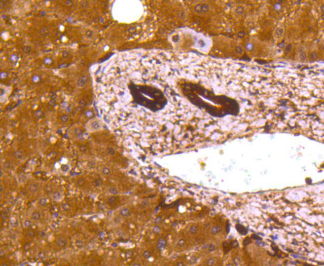 Immunohistochemical analysis of paraffin-embedded human liver carcinoma tissue using anti-Lactate Dehydrogenase antibody. The section was pre-treated using heat mediated antigen retrieval with Tris-EDTA buffer (pH 9.0) for 20 minutes.The tissues were blocked in 5% BSA for 30 minutes at room temperature, washed with ddH2O and PBS, and then probed with the primary antibody (ET1608-57, 1/50) for 30 minutes at room temperature. The detection was performed using an HRP conjugated compact polymer system. DAB was used as the chromogen. Tissues were counterstained with hematoxylin and mounted with DPX.