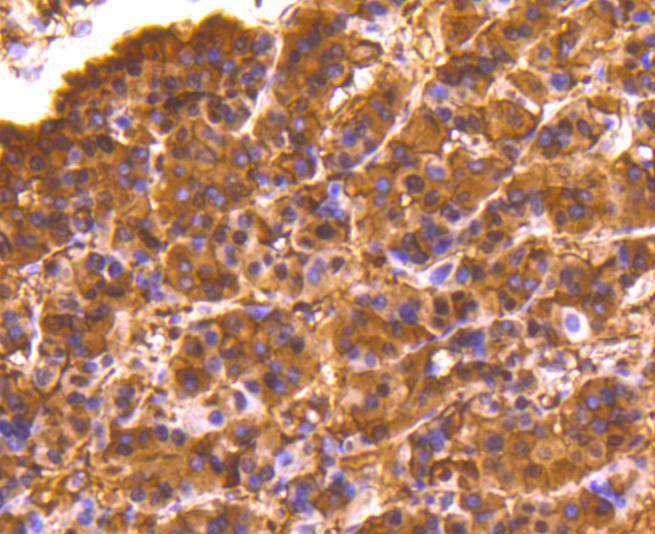 Immunohistochemical analysis of paraffin-embedded human breast carcinoma tissue with Rabbit anti-Lactate Dehydrogenase antibody (ET1608-57) at 1/2,000 dilution.<br />
<br />
The section was pre-treated using heat mediated antigen retrieval with Tris-EDTA buffer (pH 9.0) for 20 minutes. The tissues were blocked in 1% BSA for 20 minutes at room temperature, washed with ddH2O and PBS, and then probed with the primary antibody (ET1608-57) at 1/2,000 dilution for 1 hour at room temperature. The detection was performed using an HRP conjugated compact polymer system. DAB was used as the chromogen. Tissues were counterstained with hematoxylin and mounted with DPX.