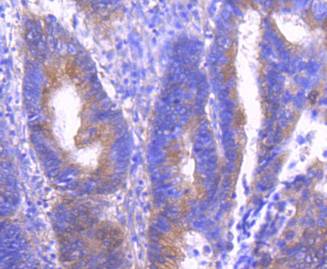 Immunohistochemical analysis of paraffin-embedded human colon carcinoma tissue using anti-Phospho-PAK1(S144)+PAK2(S141)+PAK3(S139) antibody. The section was pre-treated using heat mediated antigen retrieval with Tris-EDTA buffer (pH 8.0-8.4) for 20 minutes.The tissues were blocked in 5% BSA for 30 minutes at room temperature, washed with ddH2O and PBS, and then probed with the primary antibody (ET1608-58, 1/50) for 30 minutes at room temperature. The detection was performed using an HRP conjugated compact polymer system. DAB was used as the chromogen. Tissues were counterstained with hematoxylin and mounted with DPX.