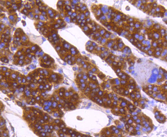 Immunohistochemical analysis of paraffin-embedded human liver carcinoma tissue using anti-Calreticulin antibody. The section was pre-treated using heat mediated antigen retrieval with Tris-EDTA buffer (pH 8.0-8.4) for 20 minutes.The tissues were blocked in 5% BSA for 30 minutes at room temperature, washed with ddH2O and PBS, and then probed with the primary antibody (ET1608-60, 1/50) for 30 minutes at room temperature. The detection was performed using an HRP conjugated compact polymer system. DAB was used as the chromogen. Tissues were counterstained with hematoxylin and mounted with DPX.
