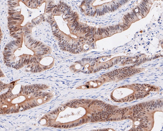 Immunohistochemical analysis of paraffin-embedded human cervical carcinoma tissue using anti-p16INK4A antibody. The section was pre-treated using heat mediated antigen retrieval with Tris-EDTA buffer (pH 8.0-8.4) for 20 minutes.The tissues were blocked in 5% BSA for 30 minutes at room temperature, washed with ddH2O and PBS, and then probed with the primary antibody (ET1608-62, 1/100) for 30 minutes at room temperature. The detection was performed using an HRP conjugated compact polymer system. DAB was used as the chromogen. Tissues were counterstained with hematoxylin and mounted with DPX.