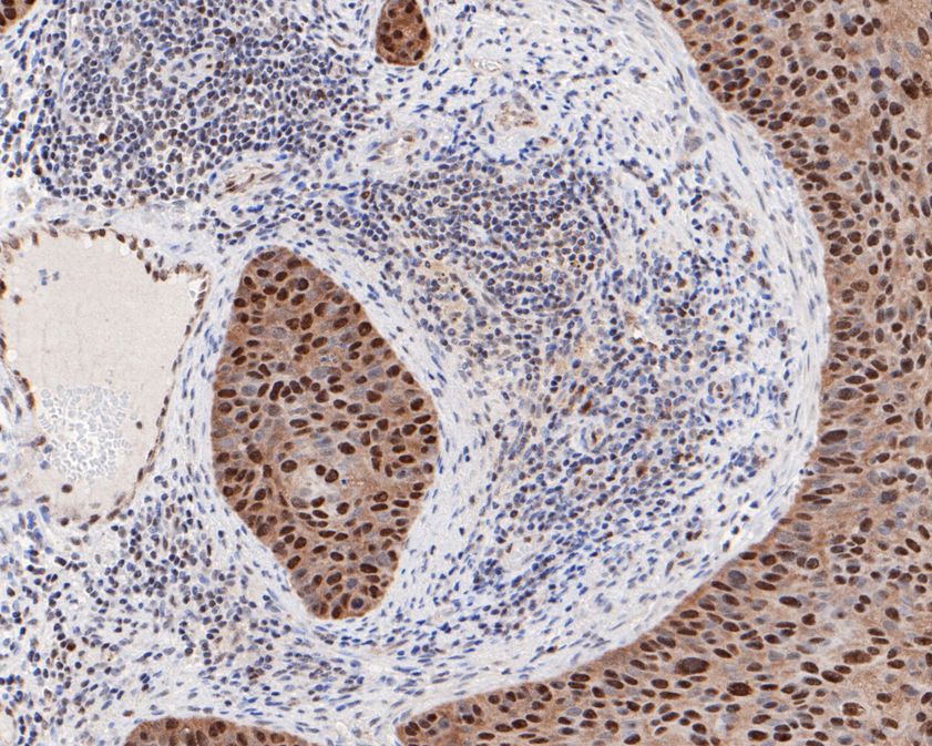 Immunohistochemical analysis of paraffin-embedded human ovary carcinoma tissue using anti-p16INK4A antibody. The section was pre-treated using heat mediated antigen retrieval with Tris-EDTA buffer (pH 8.0-8.4) for 20 minutes.The tissues were blocked in 5% BSA for 30 minutes at room temperature, washed with ddH2O and PBS, and then probed with the primary antibody (ET1608-62, 1/100) for 30 minutes at room temperature. The detection was performed using an HRP conjugated compact polymer system. DAB was used as the chromogen. Tissues were counterstained with hematoxylin and mounted with DPX.