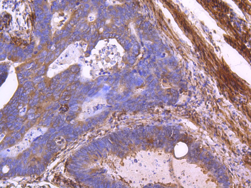 Immunohistochemical analysis of paraffin-embedded human colon carcinoma tissue using anti-Myosin light chain kinase antibody. The section was pre-treated using heat mediated antigen retrieval with Tris-EDTA buffer (pH 8.0-8.4) for 20 minutes.The tissues were blocked in 5% BSA for 30 minutes at room temperature, washed with ddH2O and PBS, and then probed with the primary antibody (ET1608-68, 1/50) for 30 minutes at room temperature. The detection was performed using an HRP conjugated compact polymer system. DAB was used as the chromogen. Tissues were counterstained with hematoxylin and mounted with DPX.