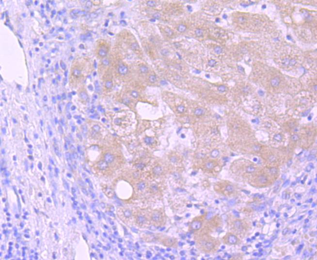 Immunohistochemical analysis of paraffin-embedded human liver carcinoma tissue using anti-PI 3 Kinase p85 alpha antibody. The section was pre-treated using heat mediated antigen retrieval with Tris-EDTA buffer (pH 8.0-8.4) for 20 minutes.The tissues were blocked in 5% BSA for 30 minutes at room temperature, washed with ddH2O and PBS, and then probed with the primary antibody (ET1608-70, 1/50) for 30 minutes at room temperature. The detection was performed using an HRP conjugated compact polymer system. DAB was used as the chromogen. Tissues were counterstained with hematoxylin and mounted with DPX.