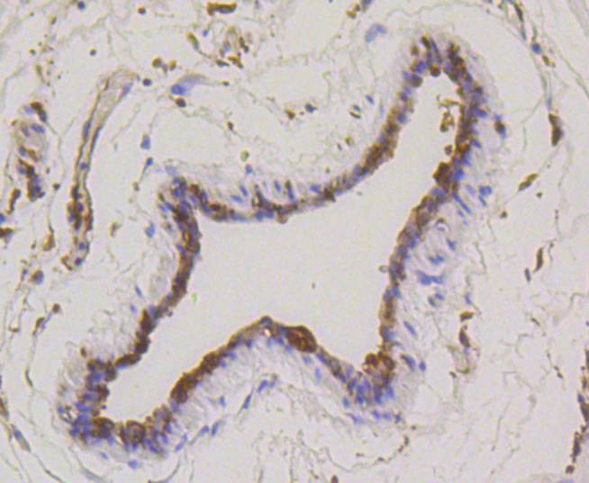 Immunohistochemical analysis of paraffin-embedded human breast carcinoma tissue using anti-Stathmin 1 antibody at 1/200 dilution. Counter stained with hematoxylin.