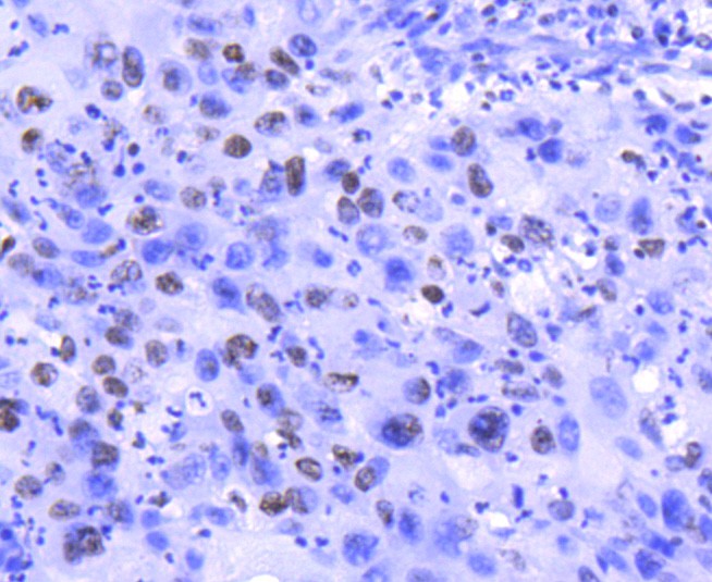 Immunohistochemical analysis of paraffin-embedded human lung carcinoma tissue using anti-Histone H2A.Z antibody. The section was pre-treated using heat mediated antigen retrieval with Tris-EDTA buffer (pH 8.0-8.4) for 20 minutes.The tissues were blocked in 5% BSA for 30 minutes at room temperature, washed with ddH2O and PBS, and then probed with the primary antibody (ET1609-23, 1/50) for 30 minutes at room temperature. The detection was performed using an HRP conjugated compact polymer system. DAB was used as the chromogen. Tissues were counterstained with hematoxylin and mounted with DPX.
