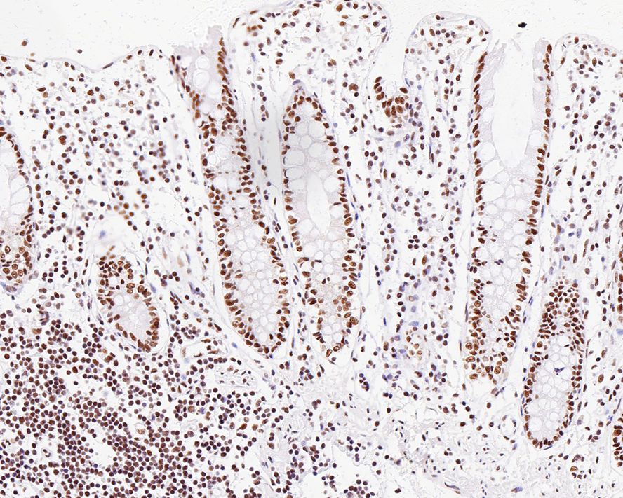 Immunohistochemical analysis of paraffin-embedded human colon tissue with Rabbit anti-ASH2L antibody (ET1609-24) at 1/1,000 dilution.<br />
<br />
The section was pre-treated using heat mediated antigen retrieval with sodium citrate buffer (pH 6.0) for 2 minutes. The tissues were blocked in 1% BSA for 20 minutes at room temperature, washed with ddH2O and PBS, and then probed with the primary antibody (ET1609-24) at 1/1,000 dilution for 1 hour at room temperature. The detection was performed using an HRP conjugated compact polymer system. DAB was used as the chromogen. Tissues were counterstained with hematoxylin and mounted with DPX.