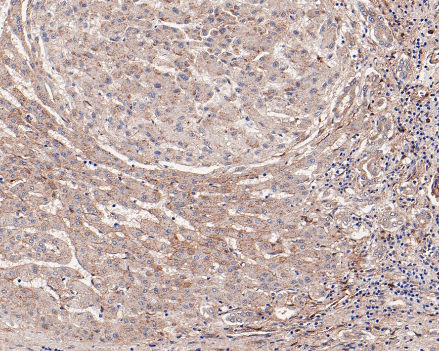 Immunohistochemical analysis of paraffin-embedded human liver tissue with Rabbit anti-MAP1LC3A antibody (ET1609-26) at 1/50 dilution.<br />
<br />
The section was pre-treated using heat mediated antigen retrieval with Tris-EDTA buffer (pH 9.0) for 20 minutes. The tissues were blocked in 1% BSA for 20 minutes at room temperature, washed with ddH2O and PBS, and then probed with the primary antibody (ET1609-26) at 1/50 dilution for 1 hour at room temperature. The detection was performed using an HRP conjugated compact polymer system. DAB was used as the chromogen. Tissues were counterstained with hematoxylin and mounted with DPX.