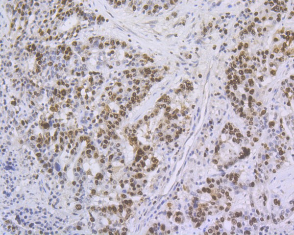 Immunohistochemical analysis of paraffin-embedded human stomach carcinoma tissue using anti-Ki67 antibody. The section was pre-treated using heat mediated antigen retrieval with sodium citrate buffer (pH 6.0) for 20 minutes. The tissues were blocked in 5% BSA for 30 minutes at room temperature, washed with ddH2O and PBS, and then probed with the primary antibody (ET1609-34, 1/50)  for 30 minutes at room temperature. The detection was performed using an HRP conjugated compact polymer system. DAB was used as the chromogen. Tissues were counterstained with hematoxylin and mounted with DPX.