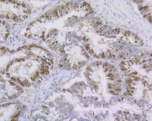 Immunohistochemical analysis of paraffin-embedded human colon carcinoma tissue using anti-Ki67 antibody. The section was pre-treated using heat mediated antigen retrieval with sodium citrate buffer (pH 6.0) for 20 minutes. The tissues were blocked in 5% BSA for 30 minutes at room temperature, washed with ddH2O and PBS, and then probed with the primary antibody (ET1609-34, 1/50)  for 30 minutes at room temperature. The detection was performed using an HRP conjugated compact polymer system. DAB was used as the chromogen. Tissues were counterstained with hematoxylin and mounted with DPX.