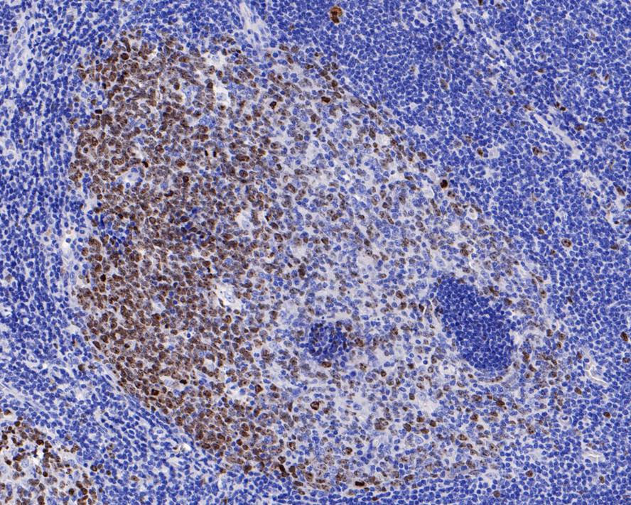 Immunohistochemical analysis of paraffin-embedded human tonsil tissue with Rabbit anti-Ki67 antibody (ET1609-34) at 1/800 dilution.<br />
<br />
The section was pre-treated using heat mediated antigen retrieval with sodium citrate buffer (pH 6.0) for 2 minutes. The tissues were blocked in 1% BSA for 20 minutes at room temperature, washed with ddH2O and PBS, and then probed with the primary antibody (ET1609-34) at 1/800 dilution for 1 hour at room temperature. The detection was performed using an HRP conjugated compact polymer system. DAB was used as the chromogen. Tissues were counterstained with hematoxylin and mounted with DPX.