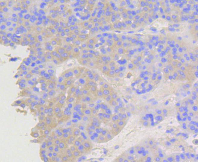 Immunohistochemical analysis of paraffin-embedded human liver carcinoma tissue using anti-beta Arrestin 1 antibody. The section was pre-treated using heat mediated antigen retrieval with Tris-EDTA buffer (pH 8.0-8.4) for 20 minutes.The tissues were blocked in 5% BSA for 30 minutes at room temperature, washed with ddH2O and PBS, and then probed with the primary antibody (ET1609-38, 1/50) for 30 minutes at room temperature. The detection was performed using an HRP conjugated compact polymer system. DAB was used as the chromogen. Tissues were counterstained with hematoxylin and mounted with DPX.