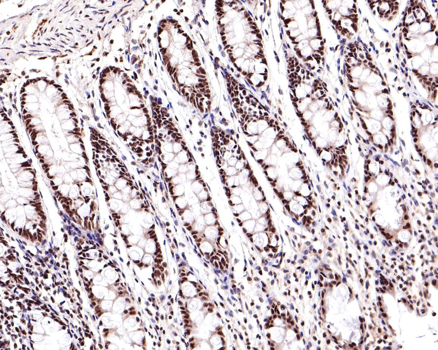 Immunohistochemical analysis of paraffin-embedded human endometrium tissue with Rabbit anti-Phospho-JNK1/2/3(T183+T183+T221) antibody (ET1609-42) at 1/400 dilution.<br />
<br />
The section was pre-treated using heat mediated antigen retrieval with sodium citrate buffer (pH 6.0) for 2 minutes. The tissues were blocked in 1% BSA for 20 minutes at room temperature, washed with ddH2O and PBS, and then probed with the primary antibody (ET1609-42) at 1/400 dilution for 1 hour at room temperature. The detection was performed using an HRP conjugated compact polymer system. DAB was used as the chromogen. Tissues were counterstained with hematoxylin and mounted with DPX.