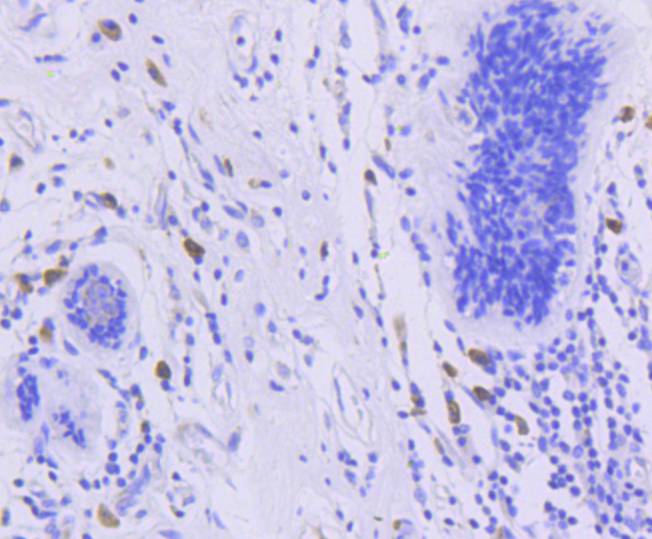 Immunohistochemical analysis of paraffin-embedded human breast carcinoma tissue using anti-Phospho-FOXO3a(S253) antibody. The section was pre-treated using heat mediated antigen retrieval with Tris-EDTA buffer (pH 8.0-8.4) for 20 minutes.The tissues were blocked in 5% BSA for 30 minutes at room temperature, washed with ddH2O and PBS, and then probed with the primary antibody (ET1609-49, 1/50) for 30 minutes at room temperature. The detection was performed using an HRP conjugated compact polymer system. DAB was used as the chromogen. Tissues were counterstained with hematoxylin and mounted with DPX.