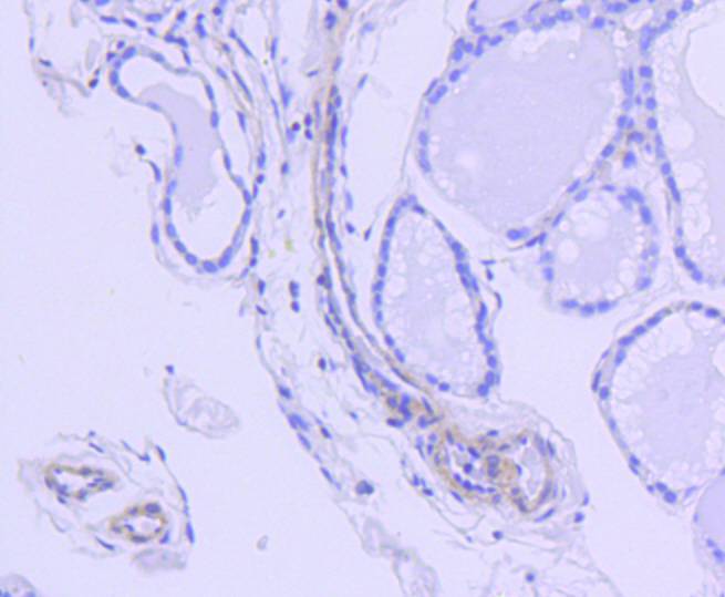 Immunohistochemical analysis of paraffin-embedded human thyroid tissue using anti-ROCK1 antibody. The section was pre-treated using heat mediated antigen retrieval with Tris-EDTA buffer (pH 8.0-8.4) for 20 minutes.The tissues were blocked in 5% BSA for 30 minutes at room temperature, washed with ddH2O and PBS, and then probed with the primary antibody (ET1609-53, 1/200) for 30 minutes at room temperature. The detection was performed using an HRP conjugated compact polymer system. DAB was used as the chromogen. Tissues were counterstained with hematoxylin and mounted with DPX.
