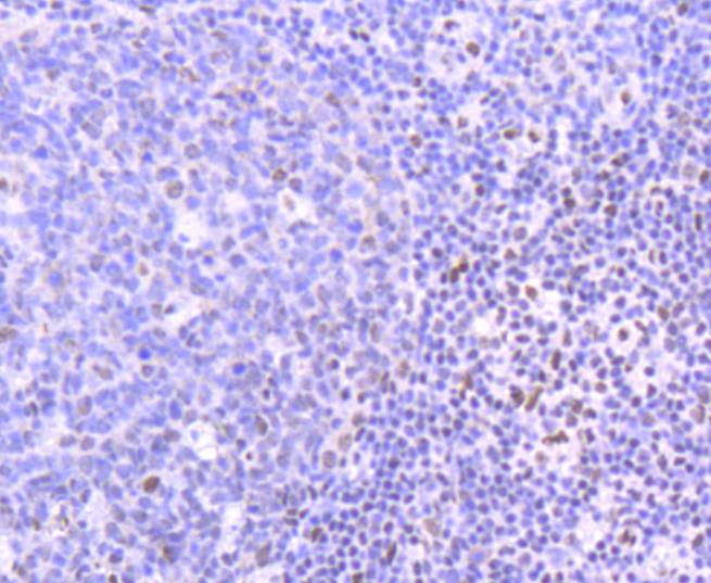 Immunohistochemical analysis of paraffin-embedded human breast carcinoma with Rabbit anti-PIM1 antibody (ET1609-57) at 1/50 dilution.<br />
<br />
The section was pre-treated using heat mediated antigen retrieval with Tris-EDTA buffer (pH 8.0-8.4) for 20 minutes. The tissues were blocked in 1% BSA for 20 minutes at room temperature, washed with ddH2O and PBS, and then probed with the primary antibody (ET1609-57) at 1/400 dilution for 1 hour at room temperature. The detection was performed using an HRP conjugated compact polymer system. DAB was used as the chromogen. Tissues were counterstained with hematoxylin and mounted with DPX.