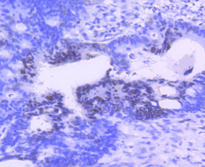 Immunohistochemical analysis of paraffin-embedded human spleen tissue with Rabbit anti-PIM1 antibody (ET1609-57) at 1/400 dilution.<br />
<br />
The section was pre-treated using heat mediated antigen retrieval with sodium citrate buffer (pH 6.0) for 2 minutes. The tissues were blocked in 1% BSA for 20 minutes at room temperature, washed with ddH2O and PBS, and then probed with the primary antibody (ET1609-57) at 1/400 dilution for 1 hour at room temperature. The detection was performed using an HRP conjugated compact polymer system. DAB was used as the chromogen. Tissues were counterstained with hematoxylin and mounted with DPX.