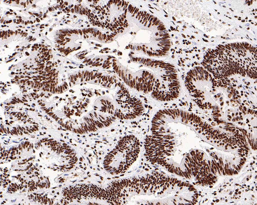 Immunohistochemical analysis of paraffin-embedded human colon carcinoma tissue using anti-Histone H3.3 antibody. The section was pre-treated using heat mediated antigen retrieval with Tris-EDTA buffer (pH 8.0-8.4) for 20 minutes.The tissues were blocked in 5% BSA for 30 minutes at room temperature, washed with ddH2O and PBS, and then probed with the primary antibody (ET1609-59, 1/200) for 30 minutes at room temperature. The detection was performed using an HRP conjugated compact polymer system. DAB was used as the chromogen. Tissues were counterstained with hematoxylin and mounted with DPX.